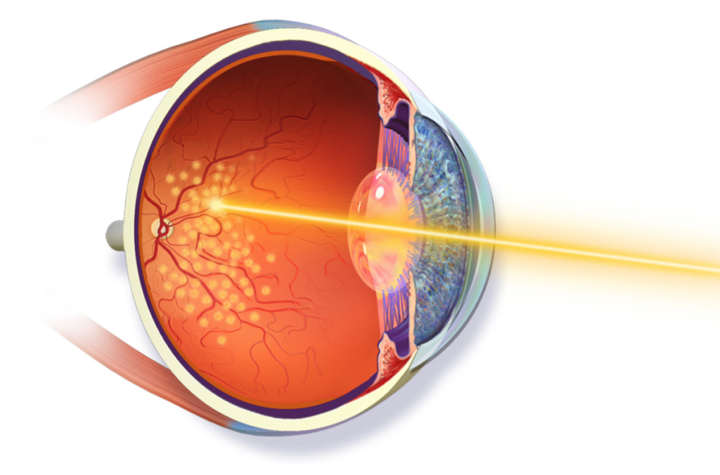 retina lasers repair Alabama